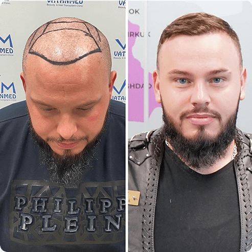 Haartransplantation
