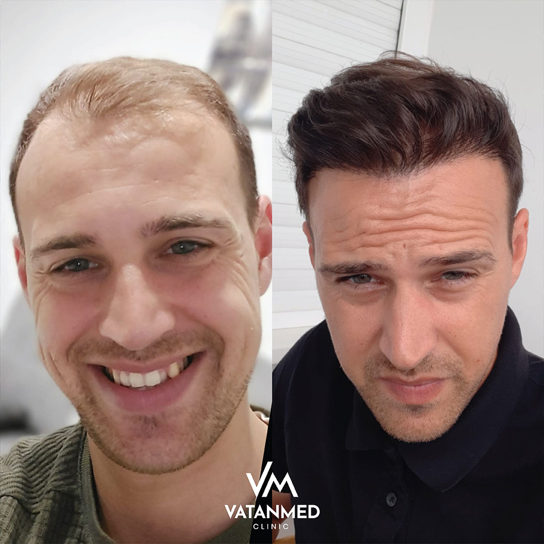 Vorher und Nachher 
