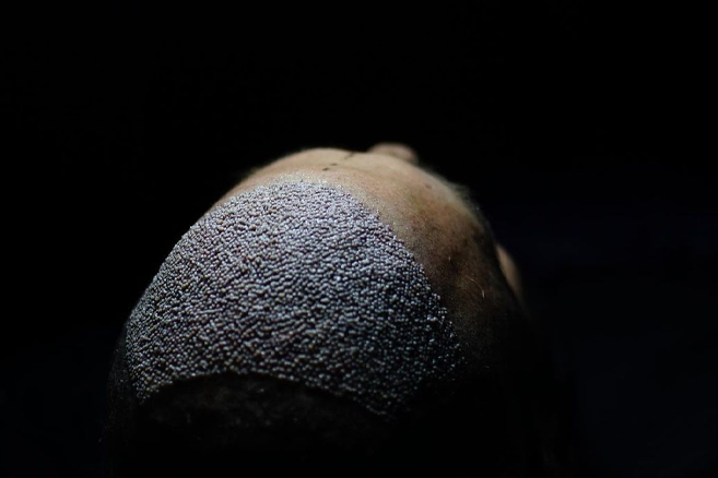 Recovery Process and What to Expect After DHI