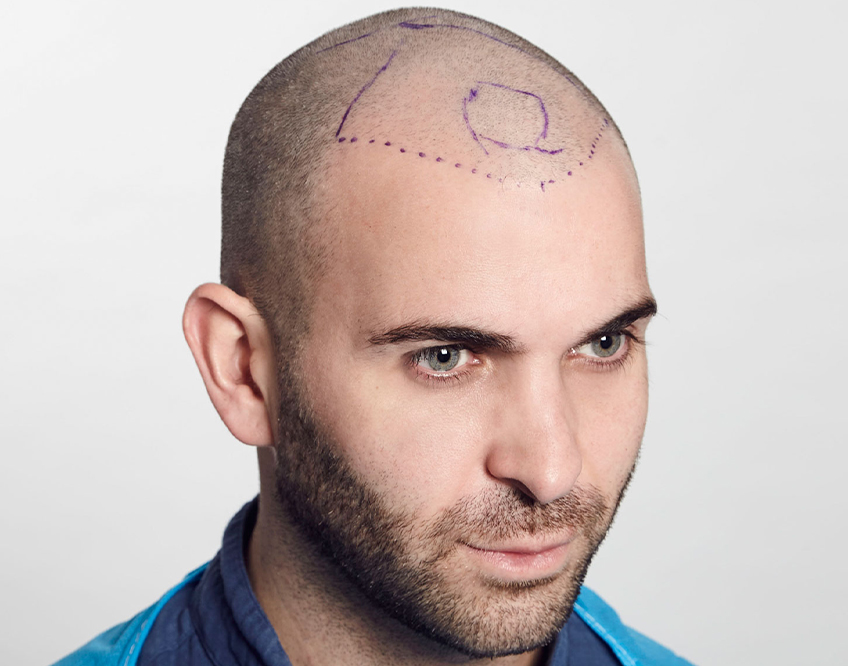 Maximum Number of Grafts for Maximum Results