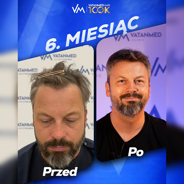 Cena: Ile Kosztuje Przeszczep Włosów w Warszawie w 2026 Roku