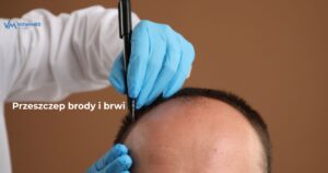 Przeszczep brody i brwi – dla kogo i jakie daje efekty? 1 przeszczep brody i brwi