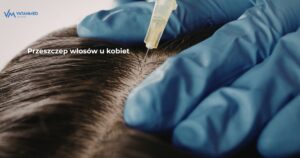 przeszczep wlosow u kobiet